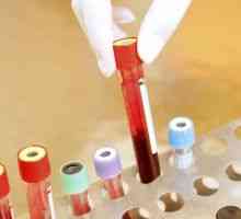 Analiza mokraće - leukociti i eritrociti: Transkript rezultata studija