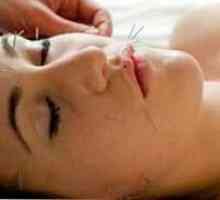 Akupunktura - novi način Lifting lica bez intervencije kirurga