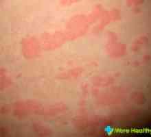 Alergijskih urtikarija: upute, liječenje i prevencija