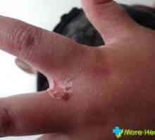 Alergični na kožu ruku: Simptomi i liječenje