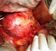 Aneurizme aorte, njegove vrste i liječenje