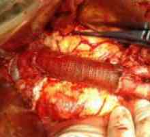 Aneurizma aorte (razmak) i njeno liječenje