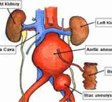 Aneurizmu abdominalne aorte i njeno liječenje