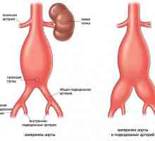 Aneurizme abdominalne aorte kao rezultat ateroskleroze