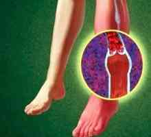 Angiopatija kod dijabetesa: noge i drugih organa - znaci, kako se postupa