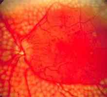 Mrežnice angiopatija oči i njeno liječenje