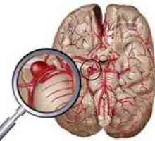 Glavni simptomi moždanog aneurizma