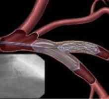 Angioplastika u liječenju vaskularnih lezija