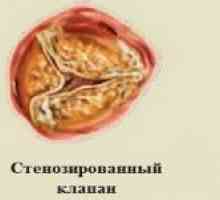 Aortalni ventil srca i njegove bolesti