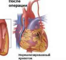 Operaciju ugradnje srčane premosnice: je li to vrijedno radi?