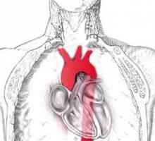 Takayasuov arteritis (nespecifično aortoarteriit): simptomi, dijagnoza, liječenje