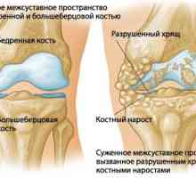 Artritis koljena