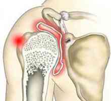 Artritis ramenu joint