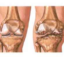 Osteoartritis koljena (gonartroza)