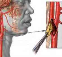 Aterosklerotske promjene u karotidnih arterija
