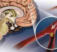 Ateroskleroze moždanih žila i njegovih simptoma