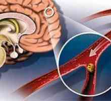 Aterosklerozu cerebralnih krvnih žila u mozgu