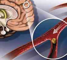 Glava Ateroskleroza: njezini uzroci, simptomi i liječenje