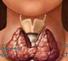 Autoimune bolesti ženskog štitne žlijezde: znakovi razaranja i liječenje tireoiditis
