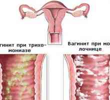 Bakterijski vaginitis i vulvovaginitis (kolpitisom)