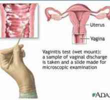 Bakterijska vaginoza (coleitis) - simptomi, dijagnostiku i liječenje metode