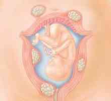 Trudnoća i porođaj miom maternice