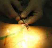 Kirurško liječenje proširenih vena na nogama
