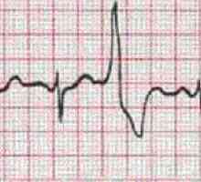 Simptomi srčane aritmije