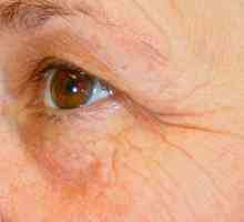 Botox na kožu oko očiju - mišljenja i opis