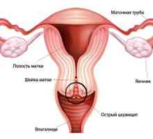 Cervikalni cervikalni ektopija i kronični cervicitis