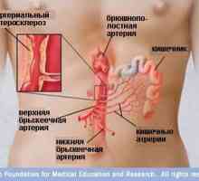 Kako opasno crijevna tromboze i kako ga liječiti?