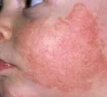 Vi ukloniti otekline od lica alergija