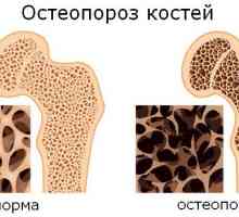 Kakav osteoporoze kosti bolesti