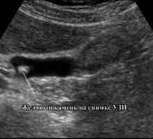 Što ultrazvuk žučni mjehur?