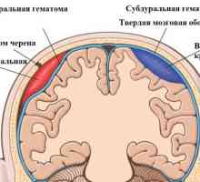 Simptomi i liječenje epiduralni hematom na mozgu