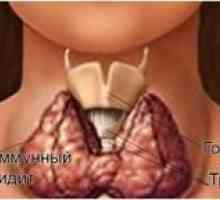 Što je Hashimotov tiroiditis štitnjače, cimptomy i liječenje bolesti