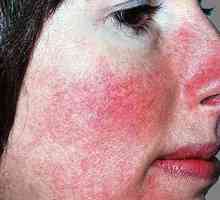 Što je rosacea ili acne rosacea: uzroci, simptomi, prevencija