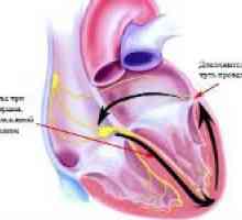 Što sindrom prerano ventrikularne