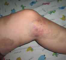 Što je ozljeda noge, a posebno njeno liječenje