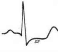 EKG znakovi srčanog angina