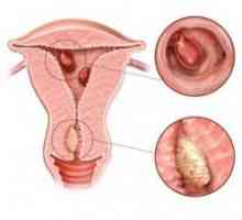 Što je glandulocystica hiperplazija endometrija