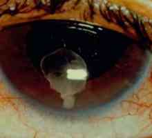 Cisticerkoza očiju: uzroci, simptomi, liječenje