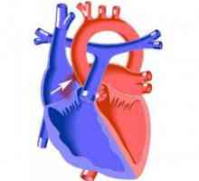 Fibrilacija septuma defekt srca u djece i odraslih: uzroci, simptomi, kako se postupa
