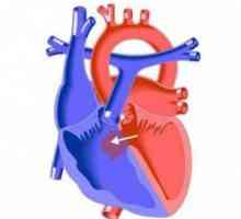 Srce defekt interventrikularni septum (VSD) uzroka, simptoma, liječenje