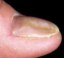 Deformacija noktiju. Uzroci, simptomi, liječenje
