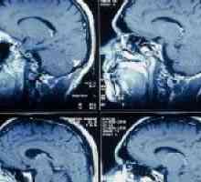 Dijagnostičke mogućnosti plovila MRI mozga