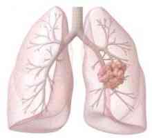 Dijagnoza i liječenje raka pluća