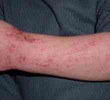 Dijeta atopijski dermatitis
