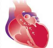 Dilatacija od srčanih komora, aorte - uvjeti, simptomi, dijagnoza, liječenje