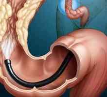 Divertikularne bolesti debelog crijeva: bolesti nakon infekcije